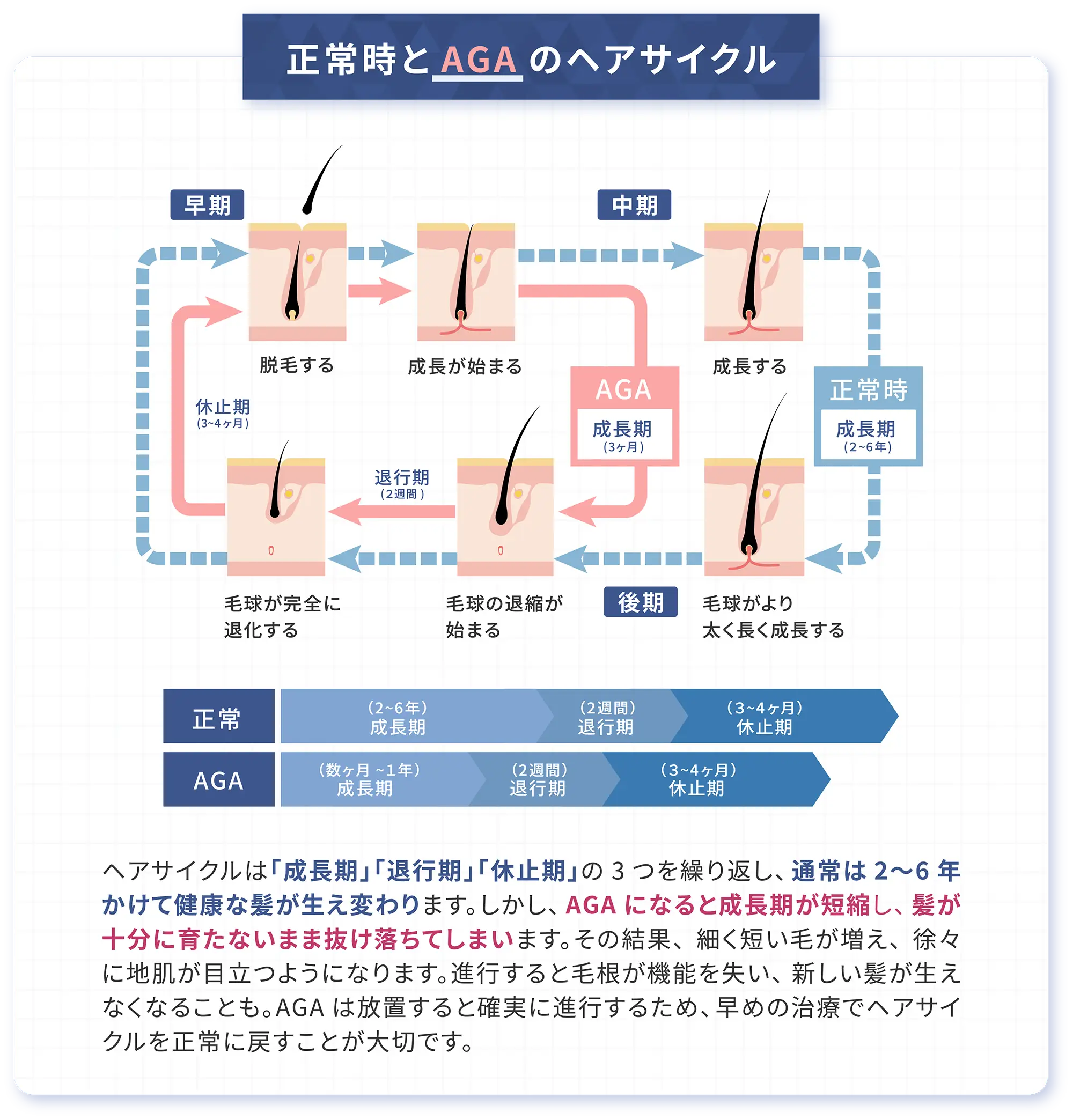 正常時のサイクルとAGAサイクルの差